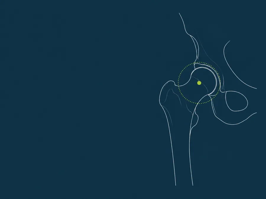 Line illustration of a hip joint with the femoral head marked